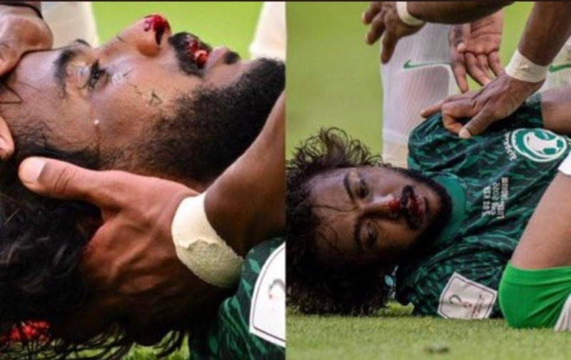 صورة حول : الاتحاد السعودي يكشف حالة اللاعب الشهراني بعد اصابته .. صور الاتحاد السعودي يكشف حالة اللاعب الشهراني بعد اصابته .. صور
