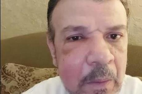 أحمد سلامة يكشف تفاصيل اصابته بورم خطير في الوجه .. فيديو