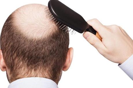 الكشف عن علاج محتمل لتساقط الشعر