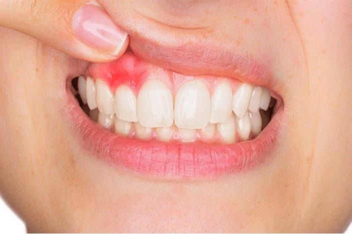 صورة حول : طرق علاج التهاب اللثة طرق علاج التهاب اللثة