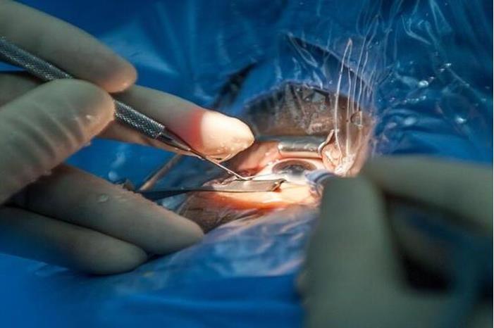 طبيب عيون يوضح كيفية التعرف على إعتام عدسة العين مبكرا