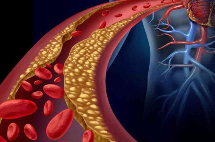 أعراض صامتة لا تتجاهلها .. تشير الى ارتفاع الكوليسترول بالدم