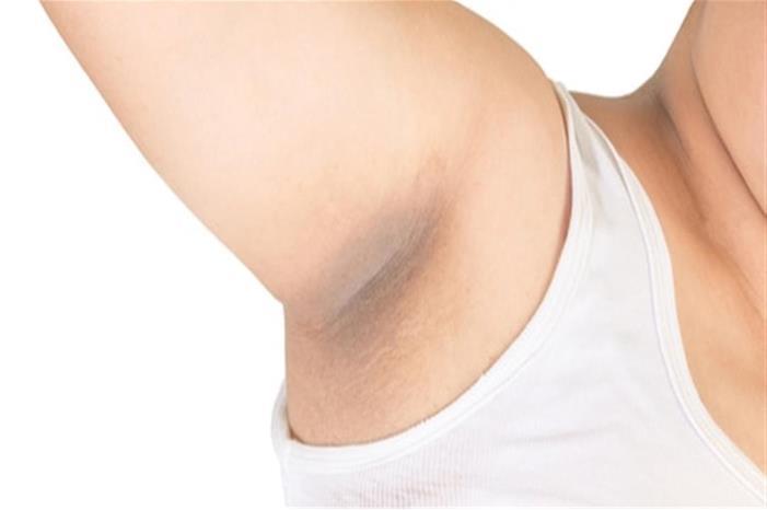 3 أسباب لاسمرار منطقة أسفل الإبط