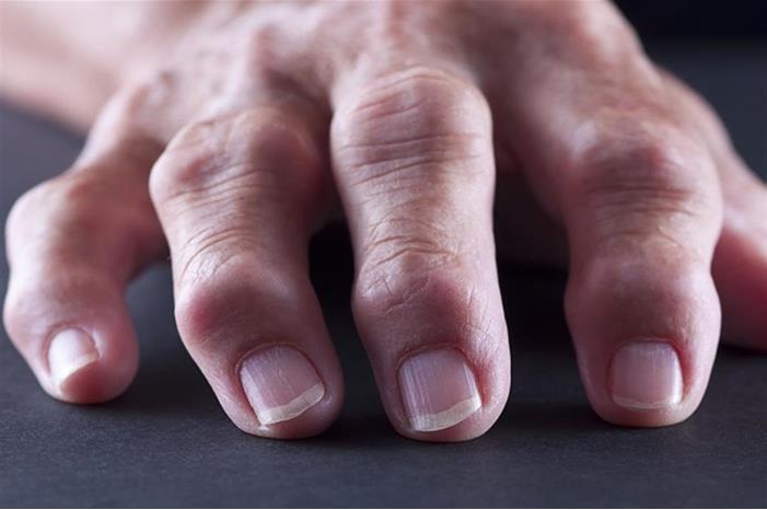 صورة حول : أعراض الفشل الكلوي..4 علامات تظهر على اليدين أعراض الفشل الكلوي..4 علامات تظهر على اليدين