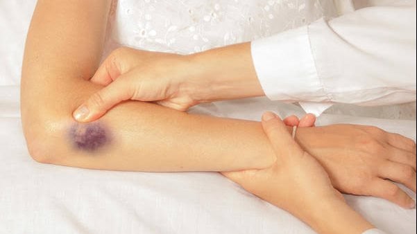 اليوم العاَلميّ للهيموفيليا