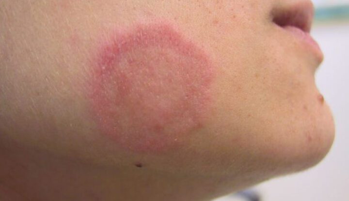 كيف تنتقل عدوى "السعفة" في حمامات السباحة