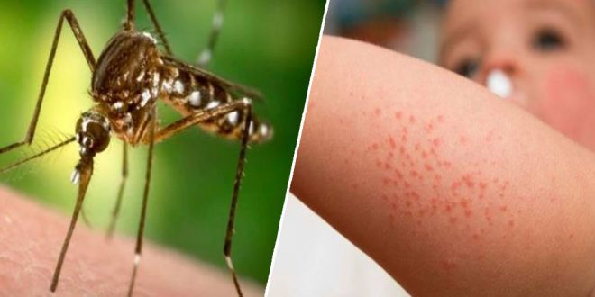 صورة حول : أعراض حمى غرب النيل وعوامل الخطر أعراض حمى غرب النيل وعوامل الخطر