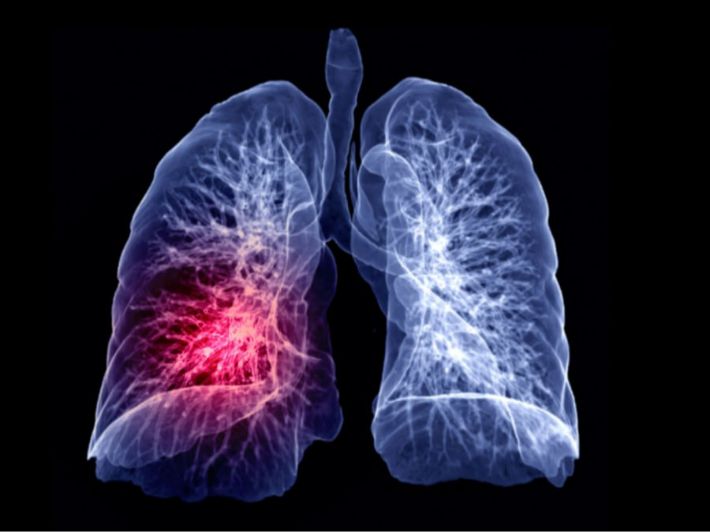 صورة حول : تعرف على علامات سرطان الرئة تعرف على علامات سرطان الرئة