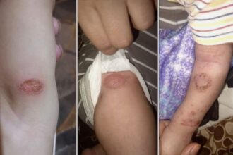 عاجل | صحّة معان تؤكد حالات الطفح الجلدي فِي المحمدية ليست مقلقة