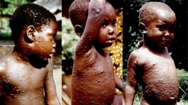 عاجل | بوروندي تحت تهديد جدري القردة .. الأطفال في خطر