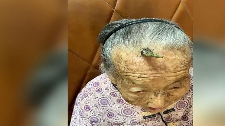 “قرن طول العمر” يظهر على جبهة عجوز صينية تبلغ 107 أعوام