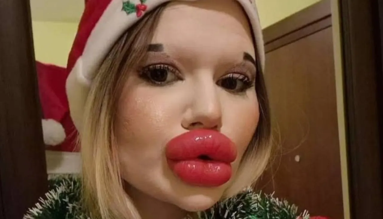 رفض طبي بسبب مظهرها.. صاحبة "أكبر شفاه في العالم" تصطدم برفض العلاج