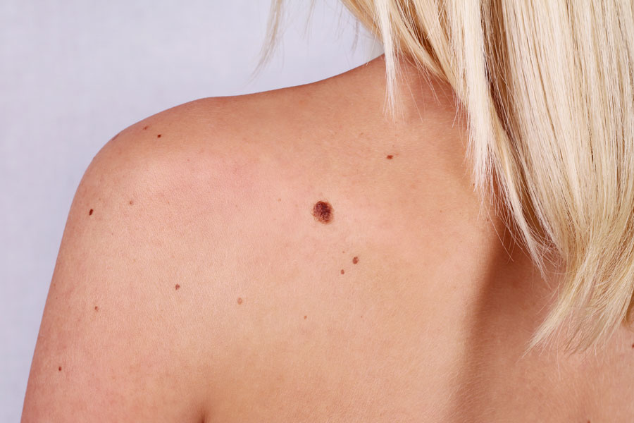 تحذير طبي .. أنتبه! بقعة حمراء قد تكون أخطر أنواع السرطان