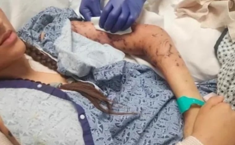 صورة حول : 10 كلاب تهاجم مراهقة وتدخلها المستشفى بـ500 غرزة في أمريكية 10 كلاب تهاجم مراهقة وتدخلها المستشفى بـ500 غرزة في أمريكية