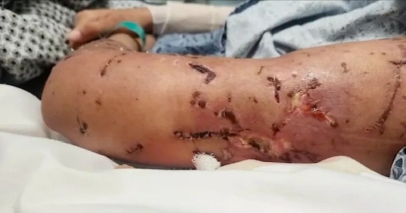 10 كلاب تهاجم مراهقة وتدخلها المستشفى بـ500 غرزة في أمريكية