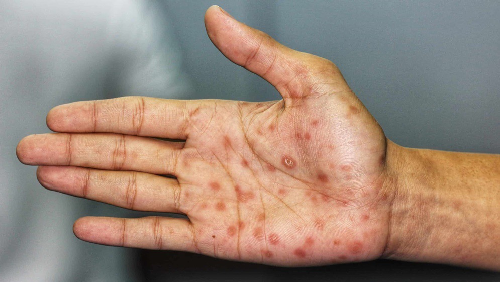 ألمانيا تسجل رقماً قياسياً جديداً في إصابات مرض الزهري