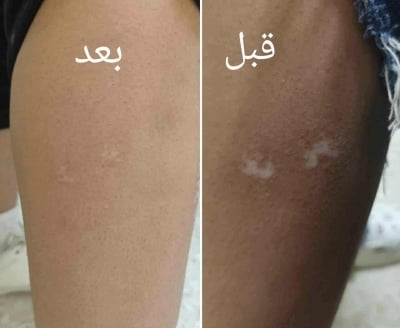 نجاح أول عمليات زراعة خلايا صبغية في مستشفى الأمير هاشم العسكري