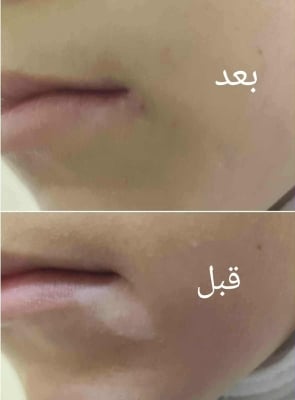 نجاح أول عمليات زراعة خلايا صبغية في مستشفى الأمير هاشم العسكري