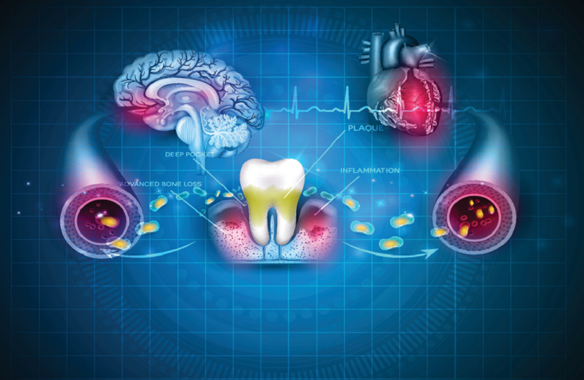 ابتسامتك قد تكلفك دماغك! دراسات تكشف صلة قوية بين أمراض اللثة وتلف الدماغ