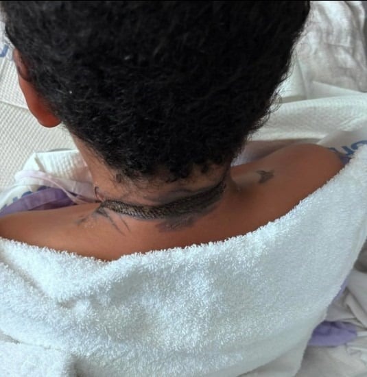 صعقة كهربائية وحروق لطفل أثناء نومه بسبب شاحن الهاتف