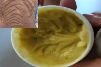 سيدة تتحول بشرتها لجلد الثعبان بعد استخدام كريم !!