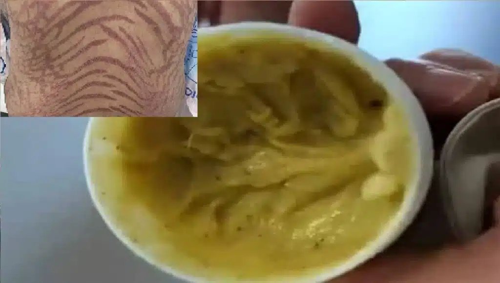 سيدة تتحول بشرتها لجلد الثعبان بعد استخدام كريم !!