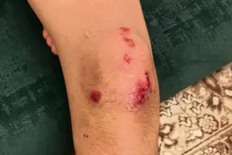 المفرق: 4 كلاب ضالة تهاجم طفلا