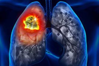 استراتيجية جديدة لاعتراض سرطان الرئة المبكر قد تحسن حياة المرضى