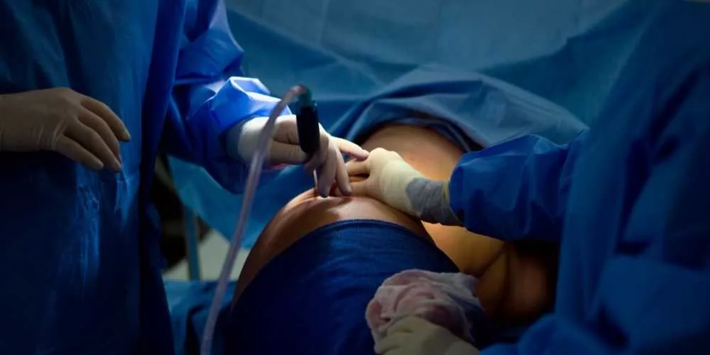 باحثون يطورون ذكاءً اصطناعيًا لتقليل مخاطر شفط الدهون