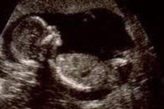 اكتشاف جنين داخل امرأة منذ 40 عامًا دون ان تشعر .. تفاصيل