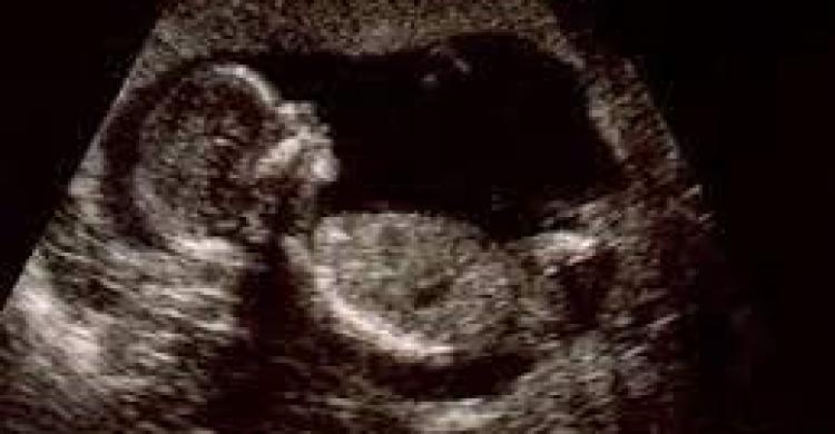 صورة حول : اكتشاف جنين داخل امرأة منذ 40 عامًا دون ان تشعر .. تفاصيل اكتشاف جنين داخل امرأة منذ 40 عامًا دون ان تشعر .. تفاصيل