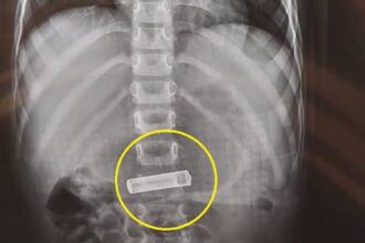 طفل أردني يبتلع بطارية ويخضع لعملية لإنقاذ حياته