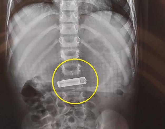 طفل أردني يبتلع بطارية ويخضع لعملية لإنقاذ حياته