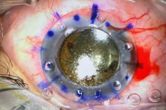 نجاح عملية نوعية لترميم انفجار مقلة العين في مستشفى الملك المؤسس