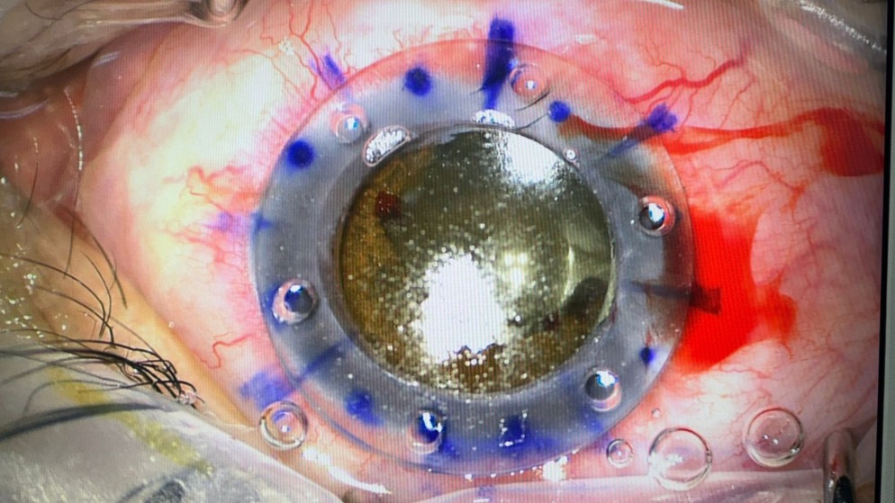 نجاح عملية نوعية لترميم انفجار مقلة العين في مستشفى الملك المؤسس