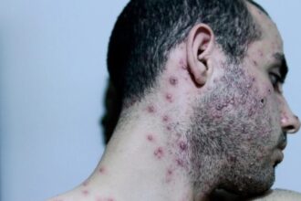 إسرائيل تسجل أول إصابة بجدري القرود من النمط الفرعي 1ب