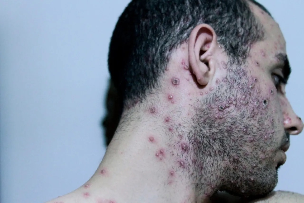 صورة حول : إسرائيل تسجل أول إصابة بجدري القرود من النمط الفرعي 1ب إسرائيل تسجل أول إصابة بجدري القرود من النمط الفرعي 1ب