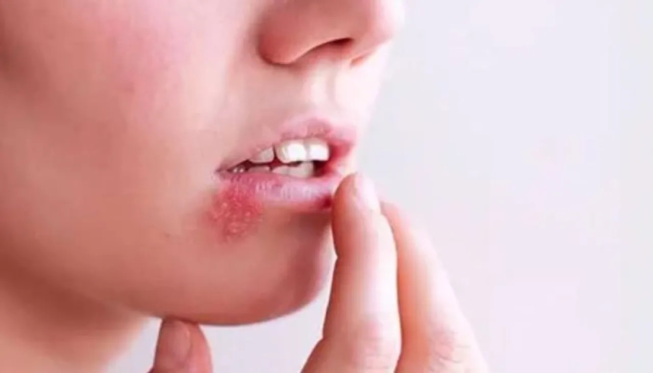 اختراق علمي في مواجهة "فيروس القبل".. أجسام مضادة بشرية تنجح في تعطيل فيروس "إبشتاين–بار"