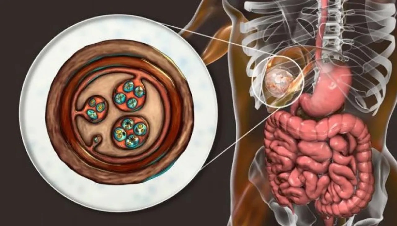 داء الأكياس المائية يهدد الأطفال في الجزائر: دراسة تكشف أخطر المناطق والآثار الصحية